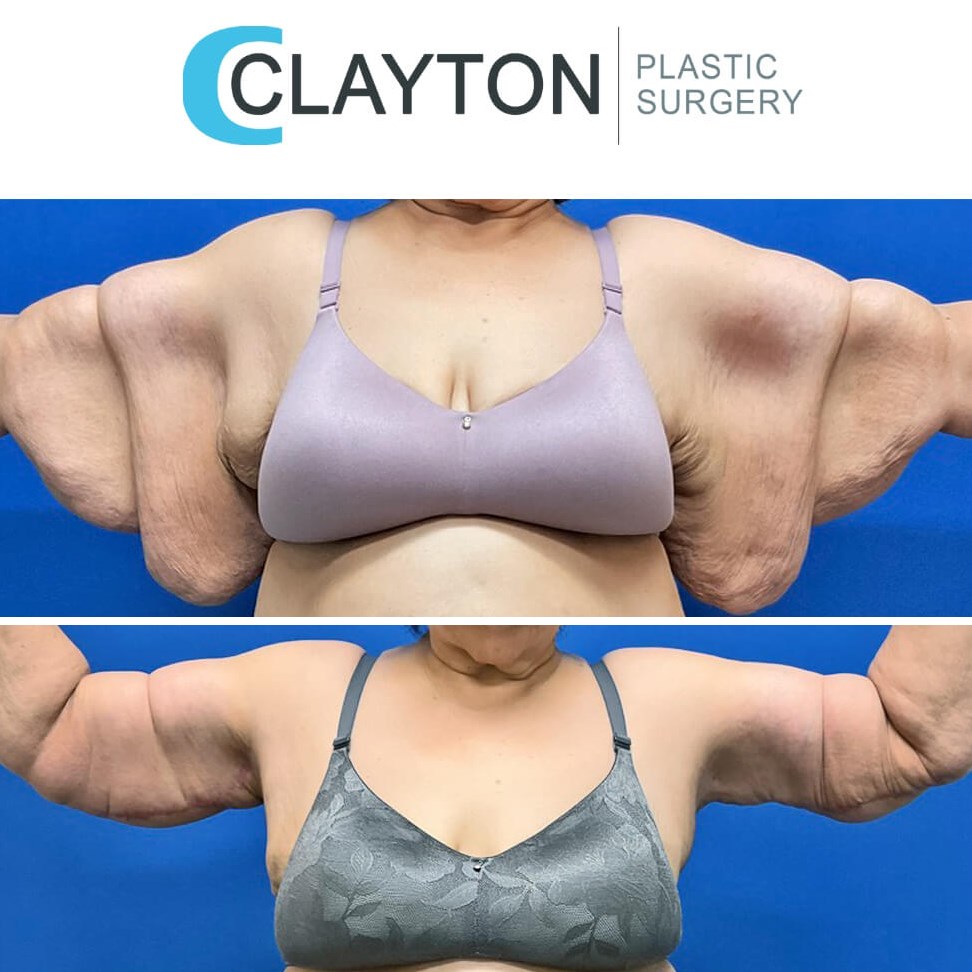 Brachioplasty Arm Lift by Dr.